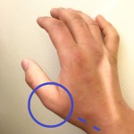 親指の付け根、突き指の痛み