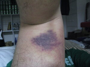 右膝ACL術後1週間くらい