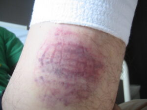 左膝ACL術後入院中