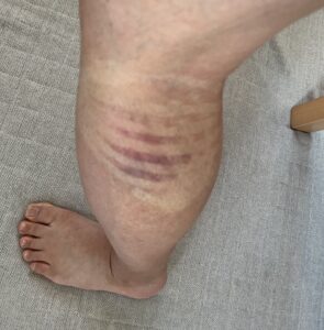 打撲青たんキネシオテープ1